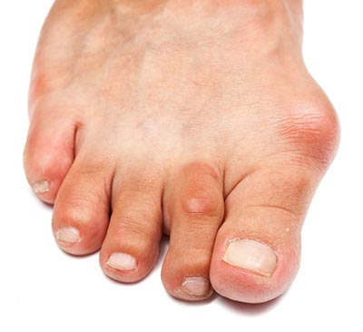 Bunion Treatment Henderson Las Vegas NV