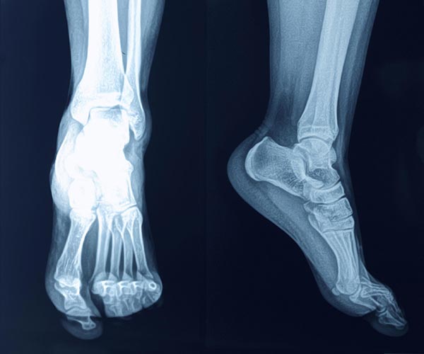 Heel Spur Causes, Symptoms and Natural Treatments - Dr. Axe